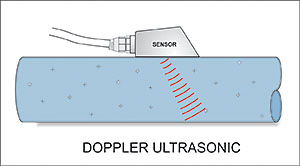 Doppler Ultrasonic Diagram